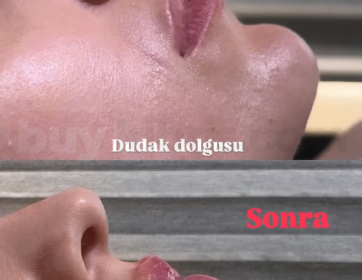 Net Profil ve Dudak Dolgunluğu