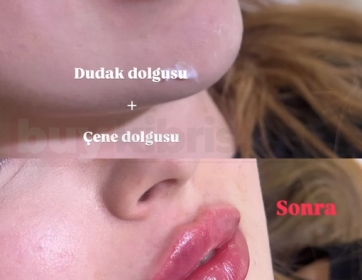 Dudak ve Çene ile Yüz Dengesi