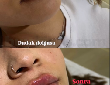 Doğal ve Parlak Dudak Dolgunluğu