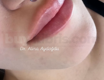 Doğal Formda Dudak Dolgunluğu