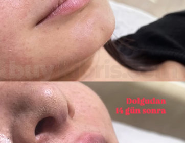14 Gün Sonra Doğal Dudak Dolgusu