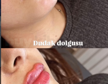 Dolgun ve Belirgin Dudak Etkisi