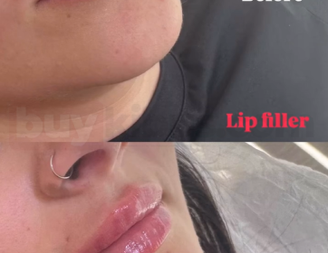 Doğal Dudak Dolgusu 